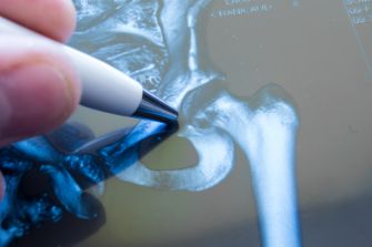 A medical professional examining an X-ray of a hip joint with a pen.