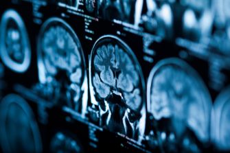 Close-up of brain scan images displayed in a medical setting.